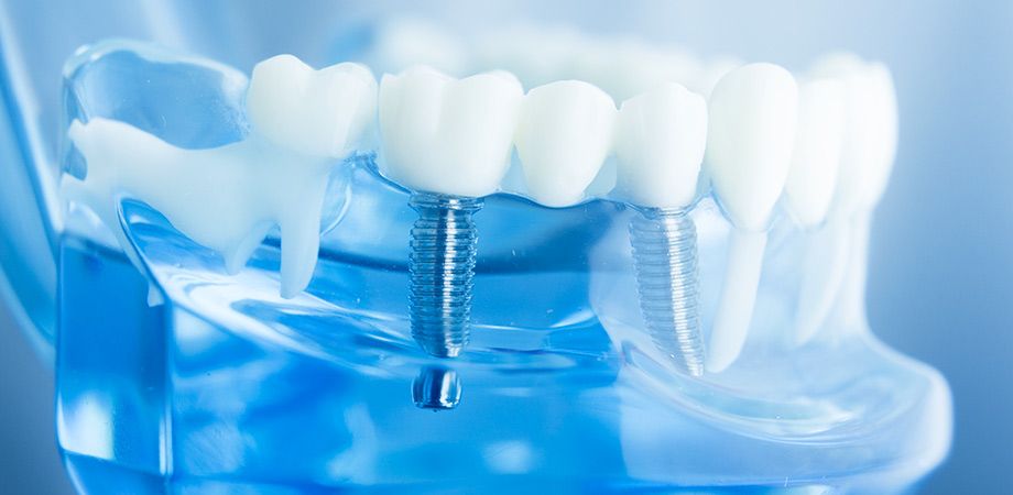 Dentista e cura delle carie