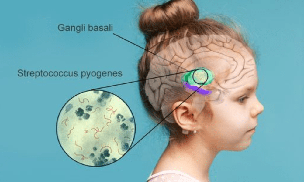 Sindrome Di Pandas | Cos’è E Come Si Cura | Quali Sono I Sintomi